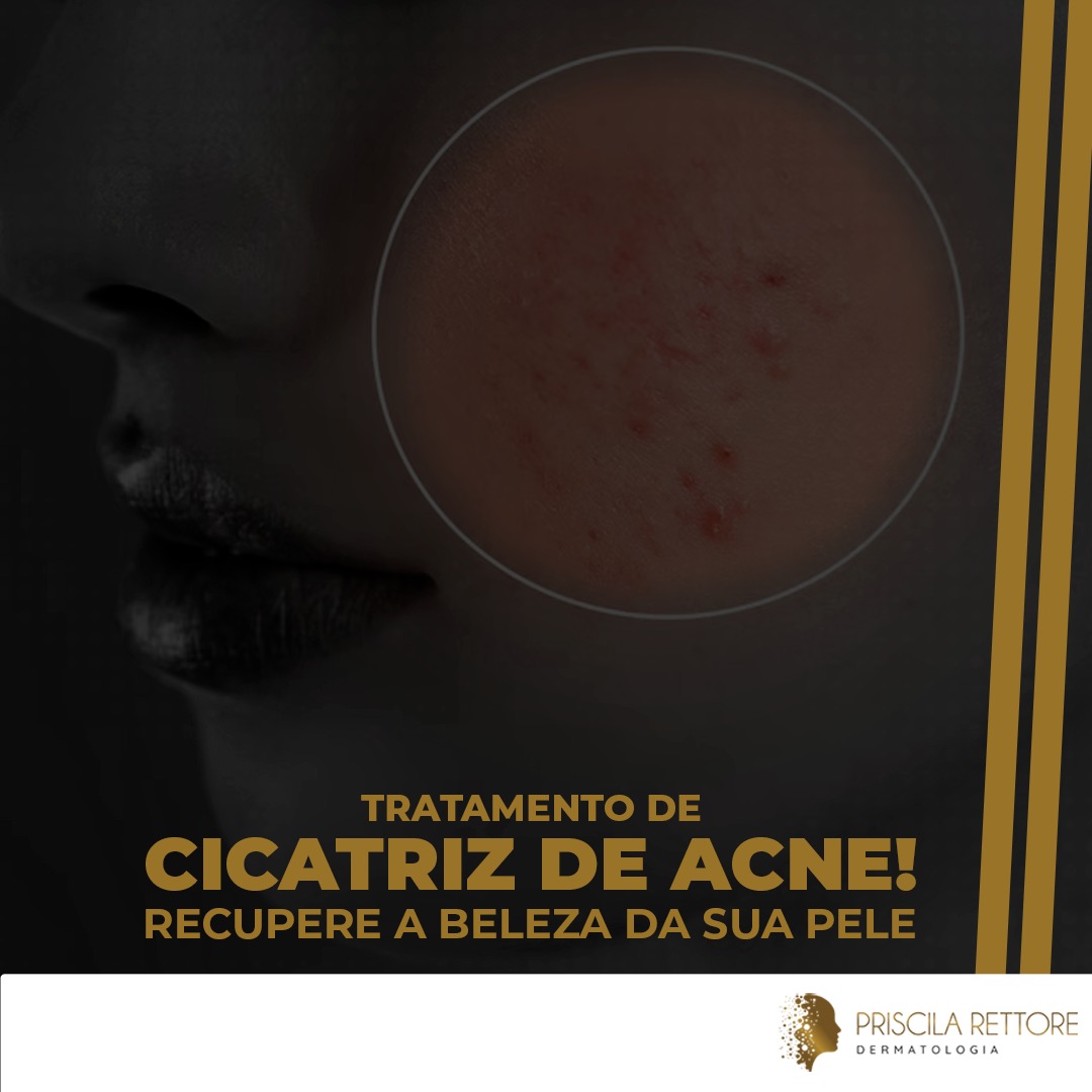 Cicatrizes de Acne