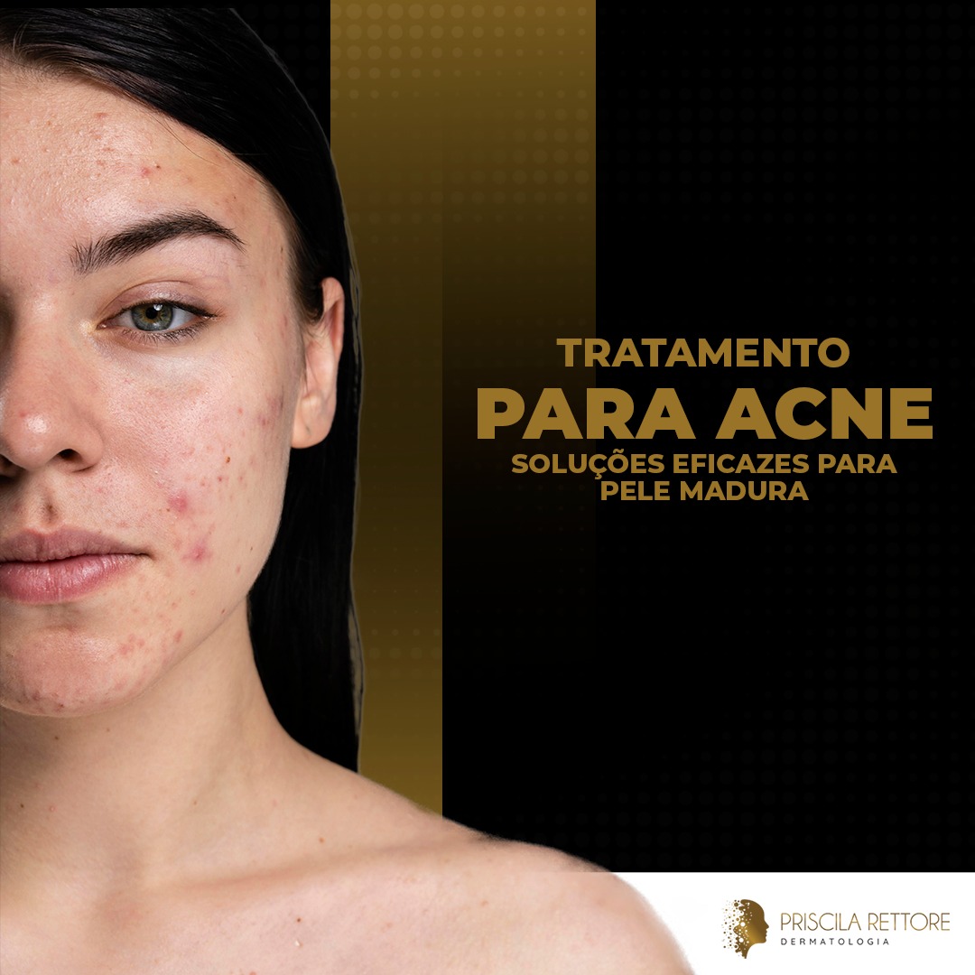 tratamento para acne