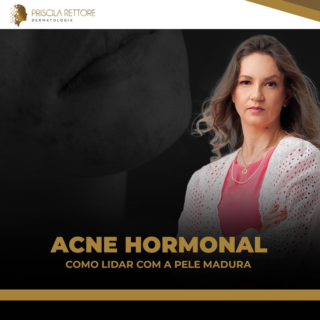 Acne Hormonal