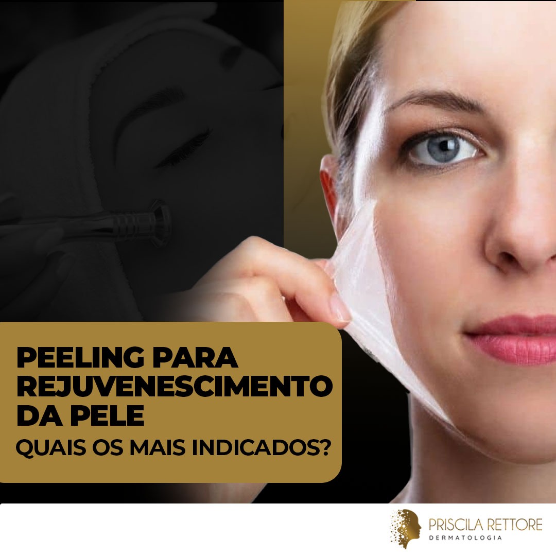 Peeling para rejuvenescimento da pele, quais os mais indicados