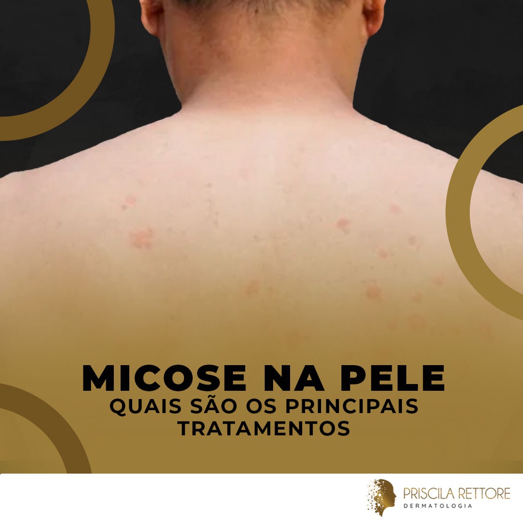 Micose na pele quais são os principais tratamentos