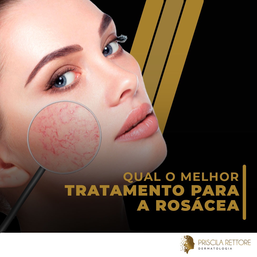 Qual o melhor tratamento para a rosácea?