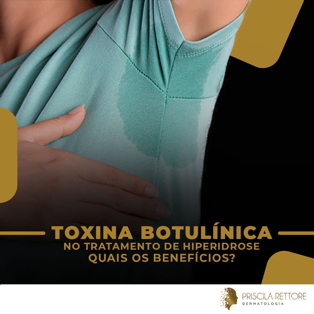 Toxina botulínica no tratamento de hiperidrose: quais os benefícios?