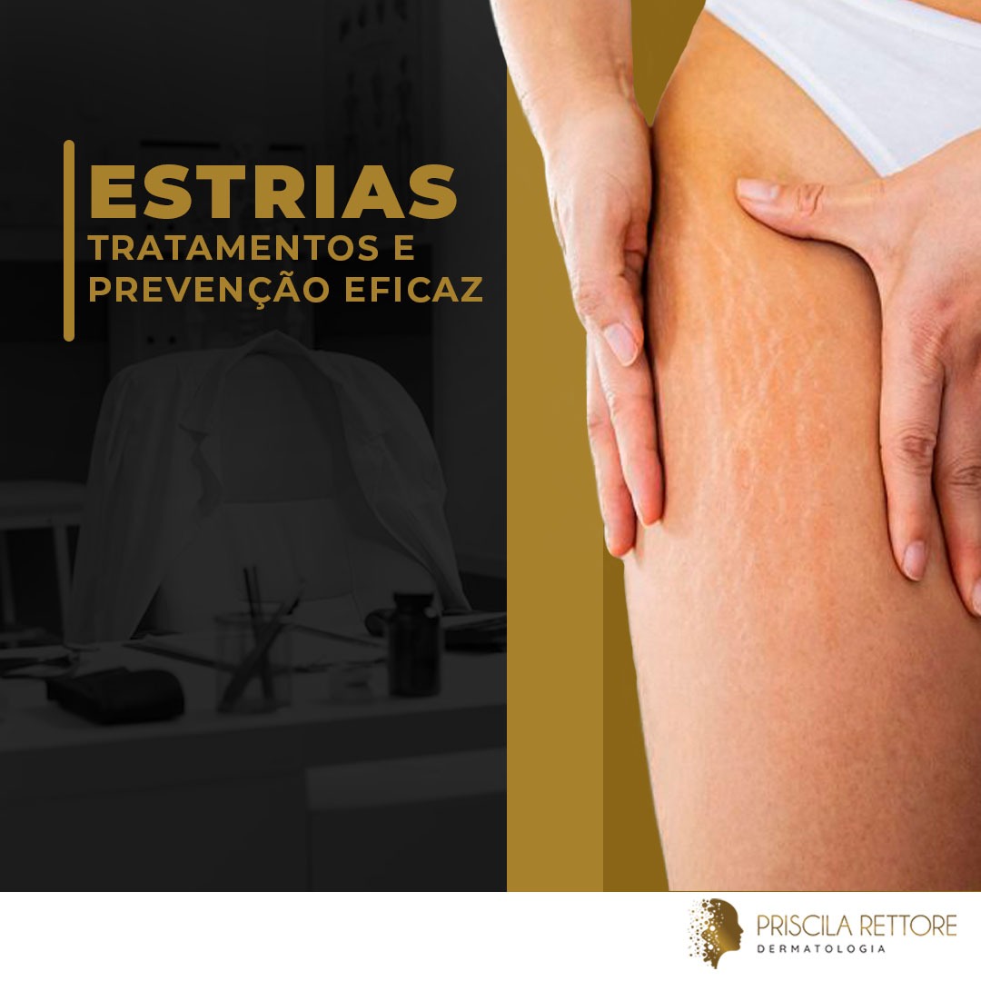 Estrias Tratamento e Prevenção Eficazes