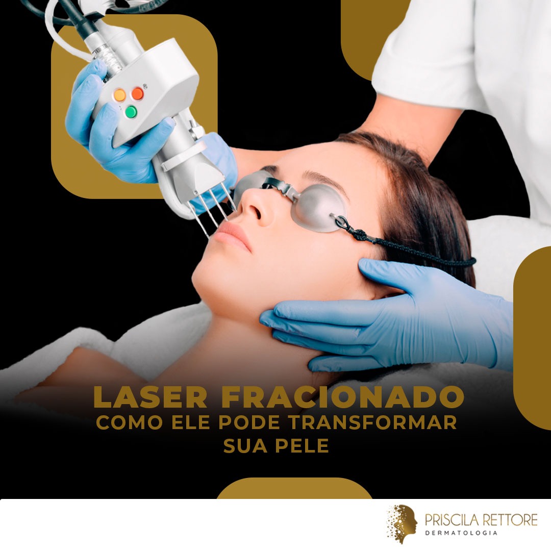 Laser Fracionado Como Ele Pode Transformar a Sua Pele