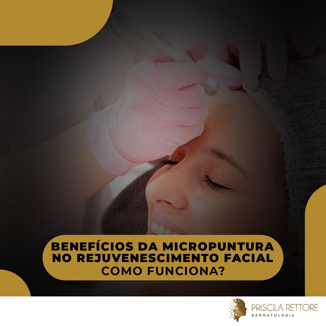 Benefícios da Micropuntura no Rejuvenescimento Facial Como Funciona