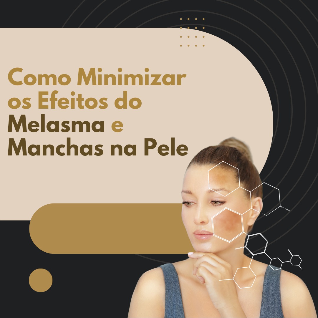 melasma