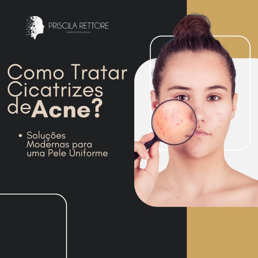 cicatrizes de acne